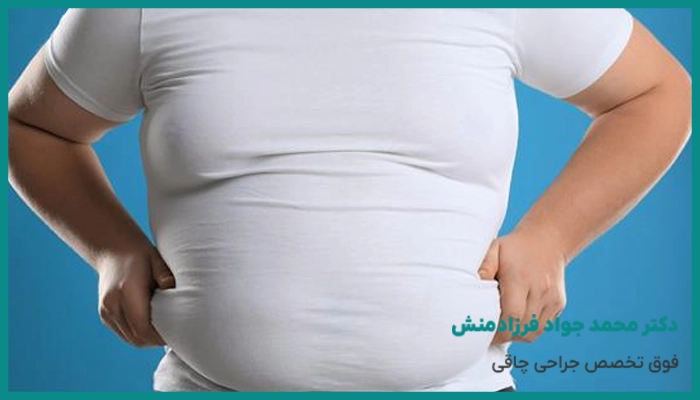 عوامل موثر بر هزینه عمل اسلیو معده